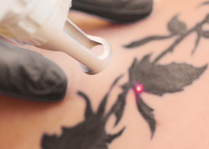 laser tattoo removal Lincoln Skegness clinics