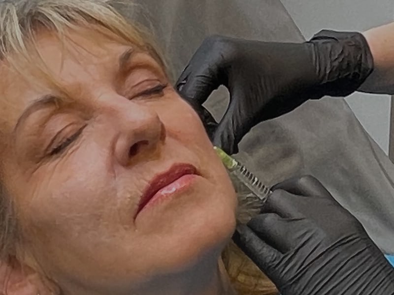 medical-aesthetic-treatments-bailgate-lincoln-03 Medical Aesthetics Practitioner Treatments Skegness